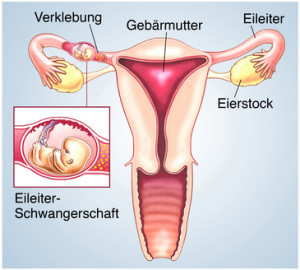 Eileiterschwangerschaft Unterleibsschmerzen