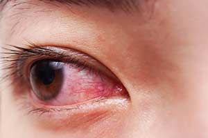 bindehautentzündung auge Kalium jodatum Augengrippe
