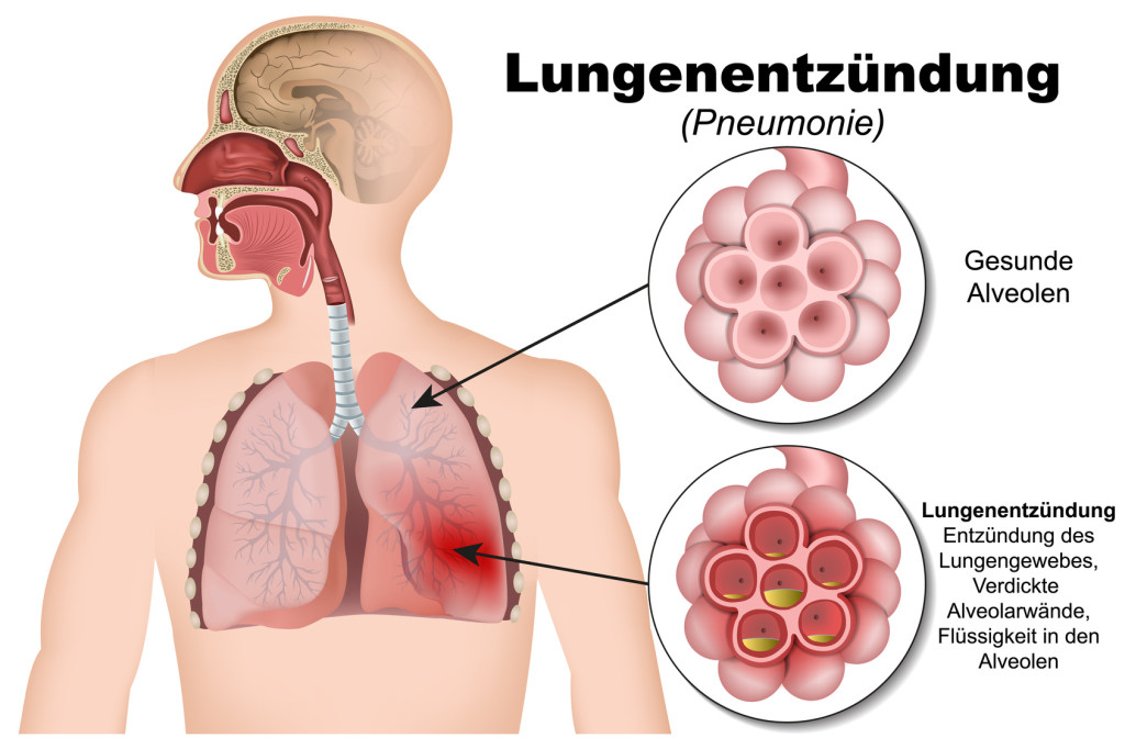 symptome lungenentzündung