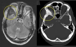 Dysplasia fibrosa