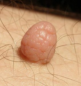 Fibroma