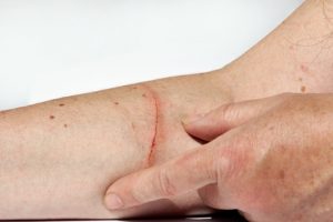 Eine blutende Verletzung am Arm einer Frau