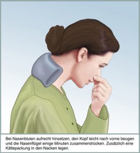 Nasenbluten, erste Hilfe. Ein kalter Waschlappen im Nacken stoppt die Blutung Symptome Nasenbluten