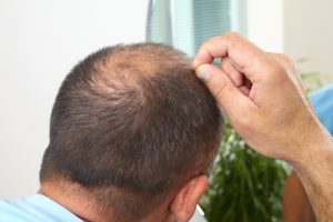 Hausmittel gegen Haarausfall