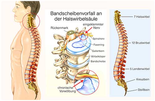 Bandscheibenvorfall halswirbelsäule