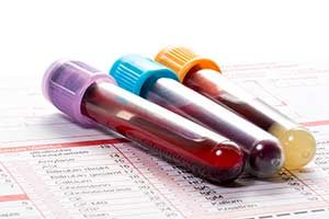 Blutwerte & Labortest, Nervenschmerzen Laktatdehydrogenase LDH, bluttest, blutuntersuchung, blutprobe