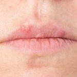Lippenherpes Herpes simplex Virus Humane Herpesviren