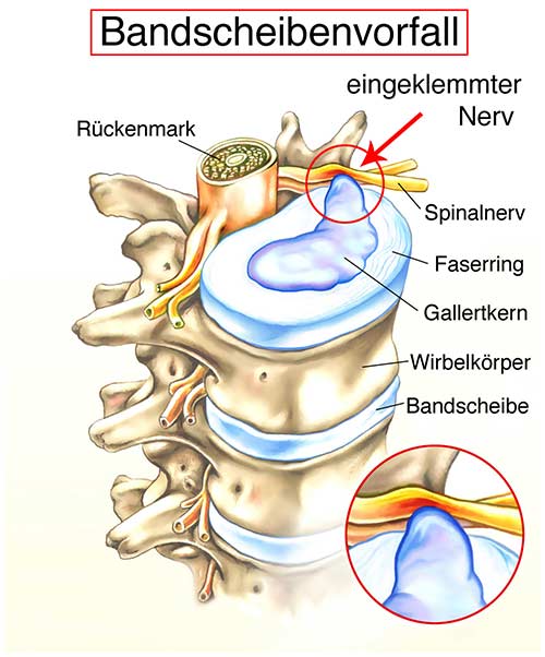 Bandscheibenvorfall darstellung