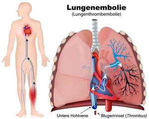 Lungenembolie darstellung