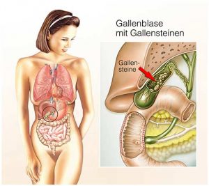 Gallenkolik darstellung Gallensteine
