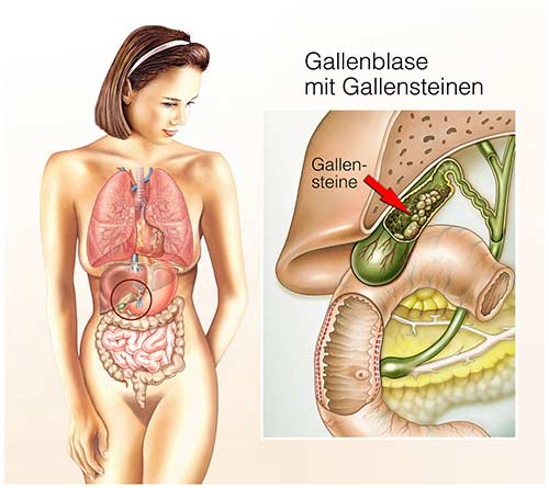 Gallenbeschwerden bauchschmerzen Beschwerden nach