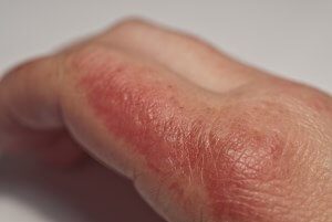 Hautrötung- Hand Linola