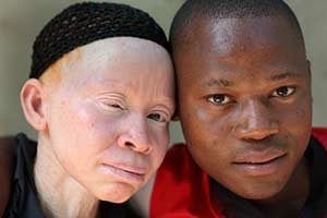 albinismus
