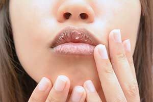 Stelle der lippe an trockene Lippenbeschwerden