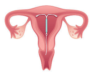 Behandlung Spirale Intrauterinpessaren