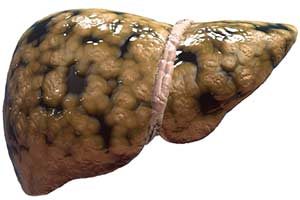 Fettleber (Steatosis hepatis)