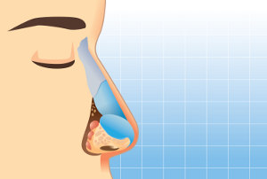 Behandlung Nasenkorrektur Symptome Nasenbluten, Schnupfen
