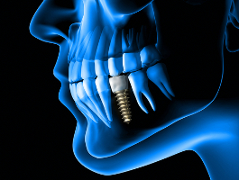 Behandlung Zahnersatz Implantat