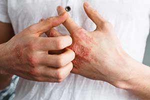 Ekzem, Dermatitis, Hautausschlag, juckreiz, haut, hände, finger, kratzen, jucken, ausschlag, rötung, pickel, pusteln, trockene haut, Neurodermitis