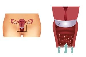 Behandlung Diaphragma