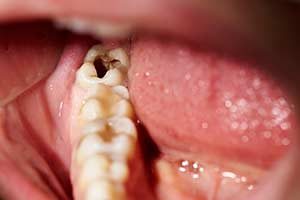 Zahnschmerzen, Karies, Zahnfäule, Zähne 