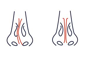 Verstopfte Nase - Symtom, Anzeichen, Ursachen, Diagnose & Behandlung ª