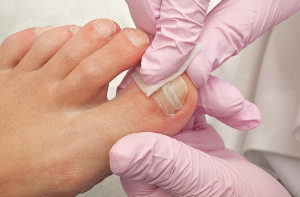 Behandlung Ciclopoli Medizinische Fußpflege Pediküre