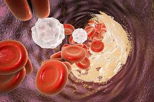 Cholesterin im Blut 3D Vanadium metallicum ApoE Genotypisierung