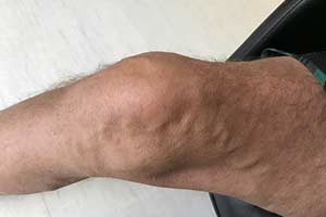Schmerzen Bein Knie