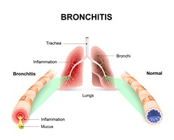 Krankheiten Bronchitis