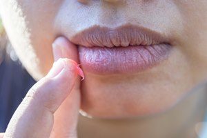 Krankheiten eingerissene Mundwinkel Hausmittel gegen Damenbart Hausmittel gegen trockene Lippen sproöde Mund