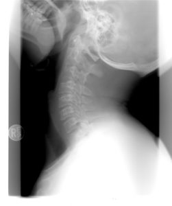 Röntgen Röntgenaufnahme Hals Halswirbelsäule Wirbelsäule Nacken Orthese Fixationsorthesen und Halswirbelsäulenschiene