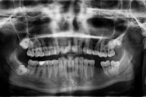 zahnunfall röntgen x ray , zähne , zahn fehlt zahnlücke