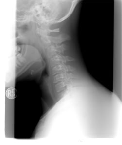 halswirbelsäule, hws, nacken, hals, räntgen, x ray