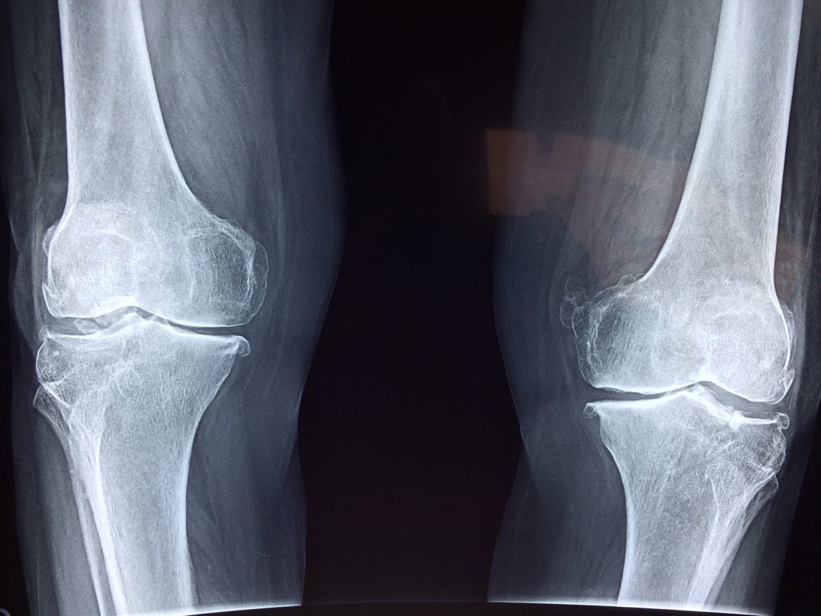 Meniskus Anatomie, Funktion, Beschwerden » Krank.de