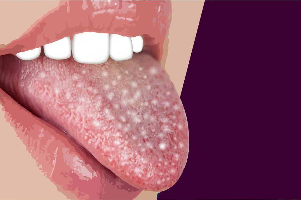 Angina Ursachen, Symptome, Diagnose & Behandlung & Hausmittel » Krank.de