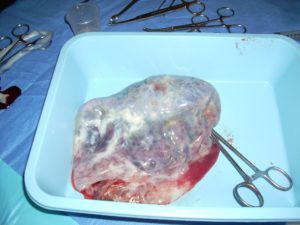 plazenta , nabelschnur , geburt , medizinische , blut , schnur , schwangerschaft , neugeborenes, baby, embryo, fötus
