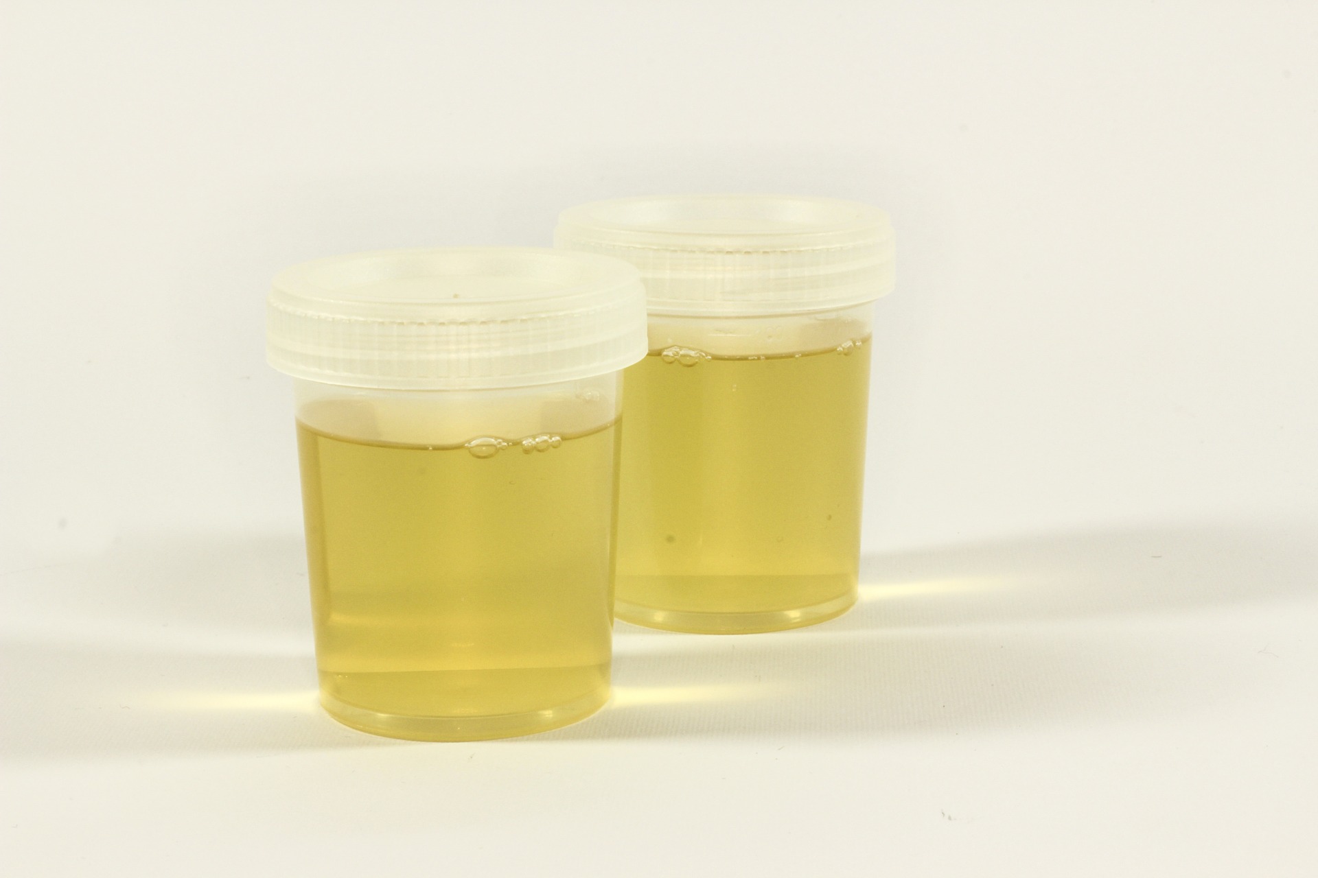 was ist eiweiss im urin ursachen symptome behandlung krank de