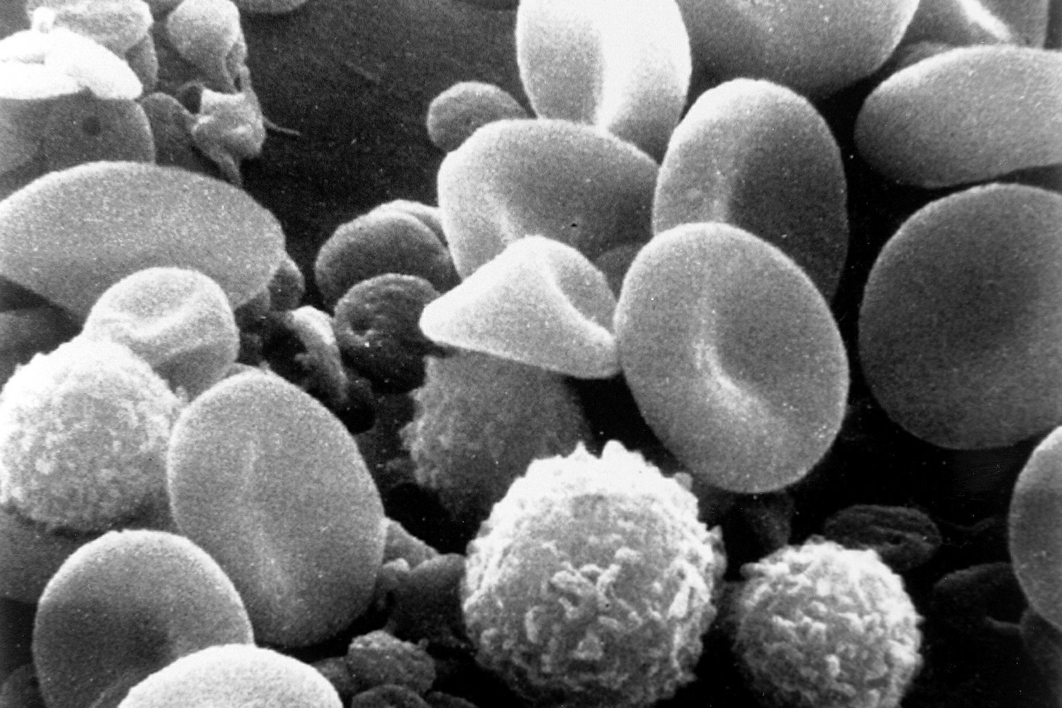 was ist eine thrombozytopenie ursachen symptome behandlung krank de