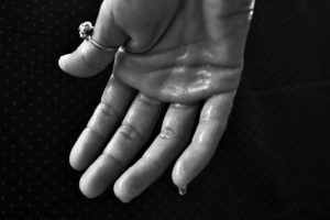 hand , hyperhidrose , schwitzen , schweißdrüsen , ausbruch , reinigung , syndrom , comporea hochtemperatur , kein fieber , geruchlose flüssigkeit , programmierung fehler , thermostat , hypothalamus , schweiß , klitschnass , nass , grondande , schweiß gebadet , suppe , taufeucht