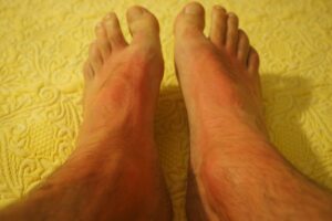 sonnenbrand , füße , haut , rot , verbrannt , gerötet , allergie , hautirritation , körperteil , rötung , sonne , hitze , schmerz , gefahr , hautkrebs , dermatologie , mann, Wundrose